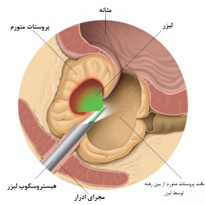 داروهای ضد هایپرپلازی پروستات