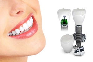 ایمپلنت اندواستیل یک فرورونده