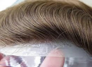 نصب پروتز مو