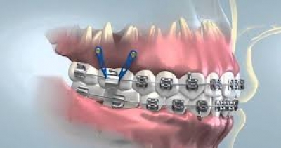 نمودارهای دندان